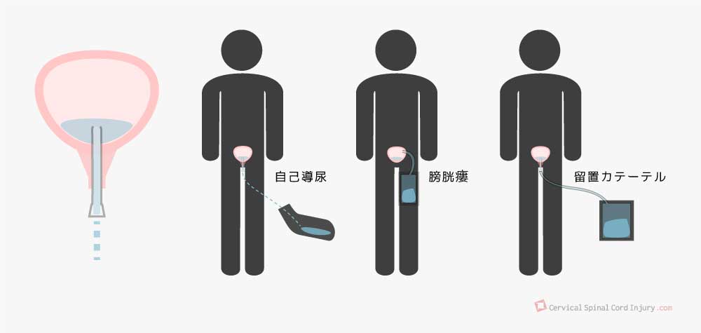 自己導尿・膀胱瘻・留置カテーテル